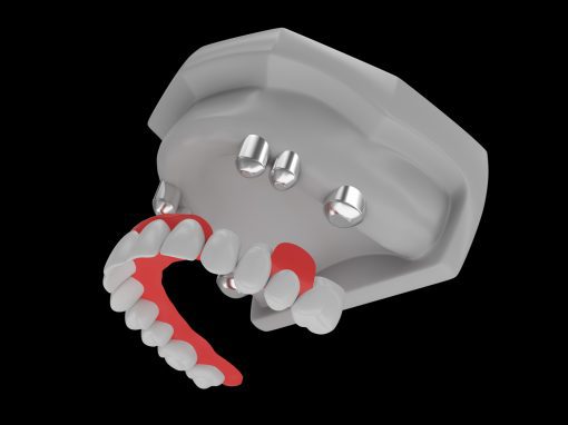 Zahnersatz Dental Protheses